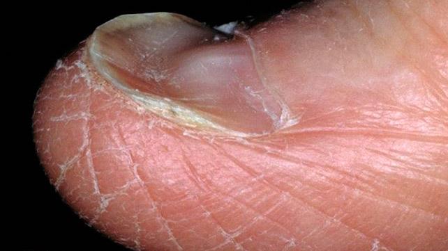 A lack of iron in the diet may cause koilonychia.