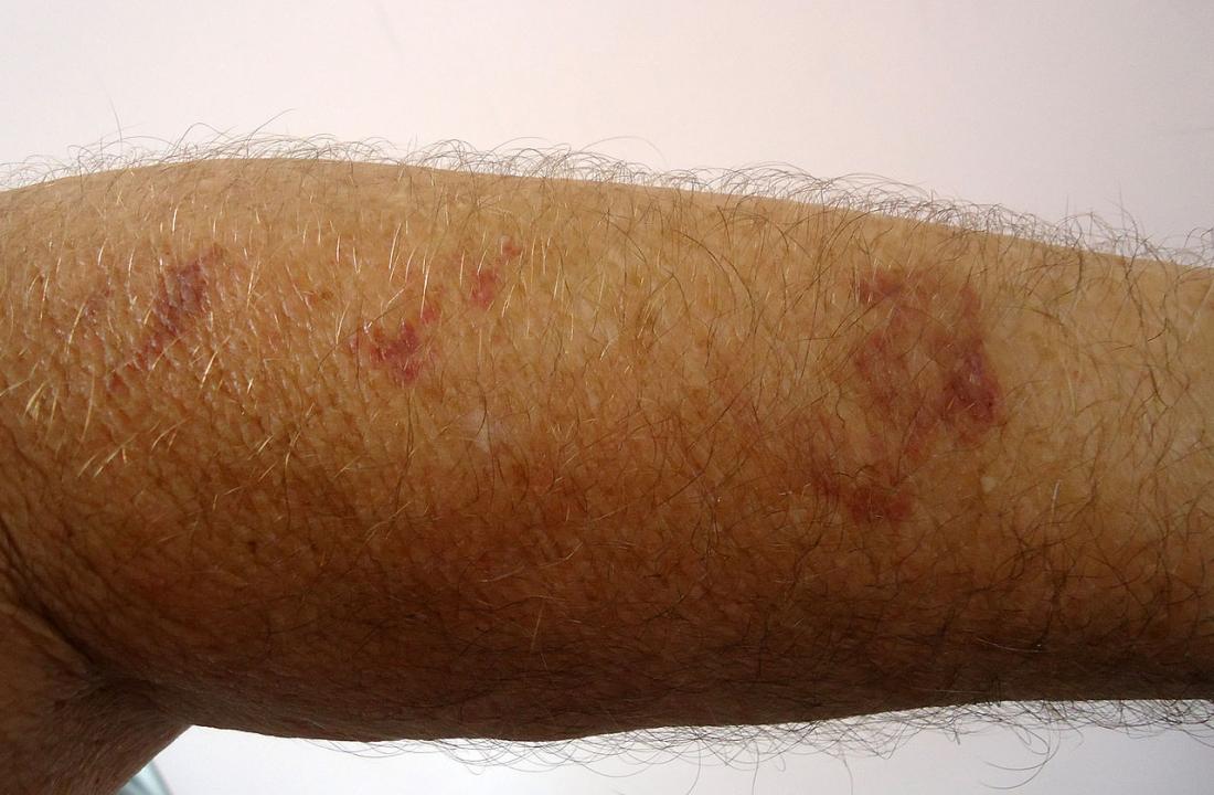 purpura on arms