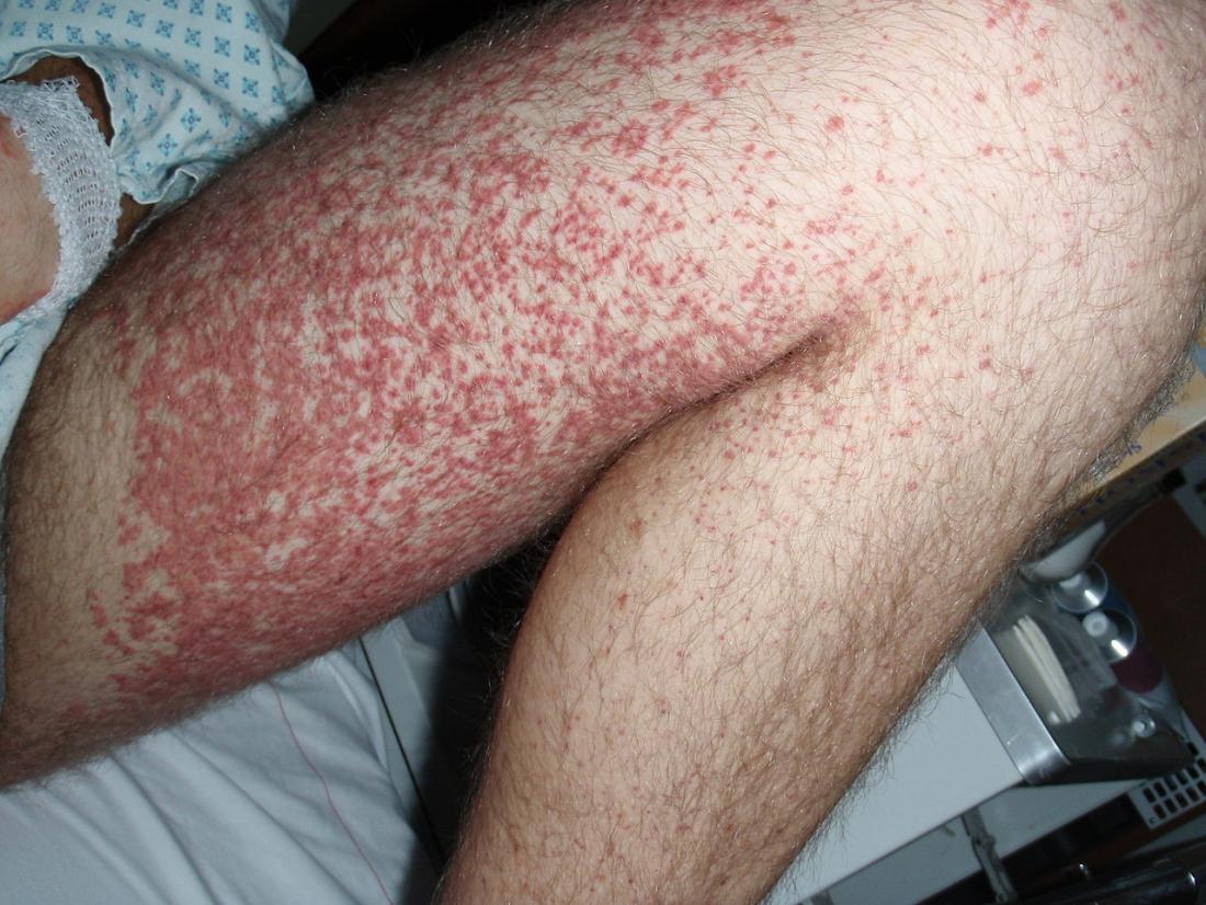 Henoch Schönlein Purpura Causes Symptoms And Treatment