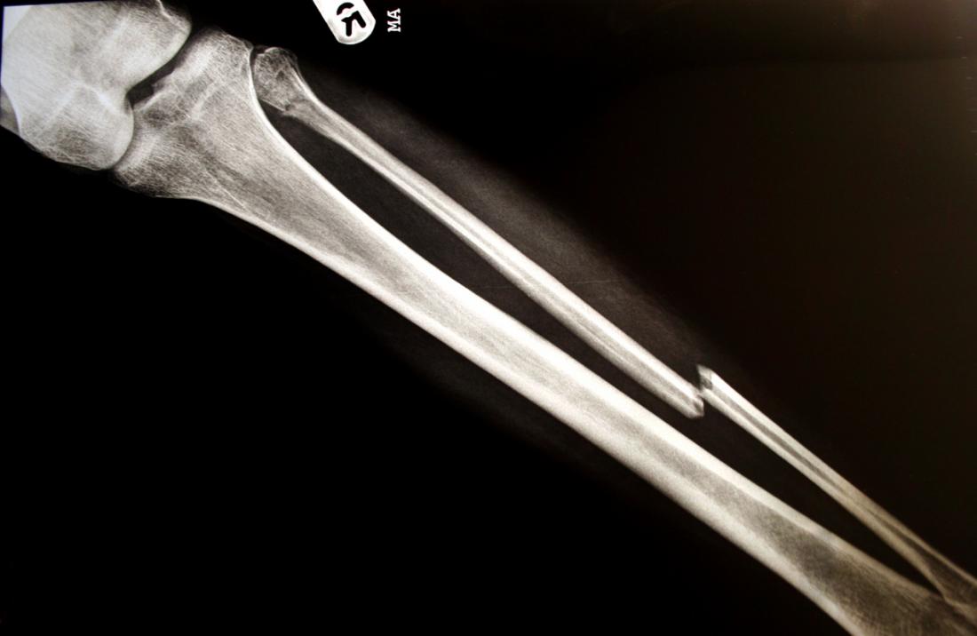 broken shin x ray