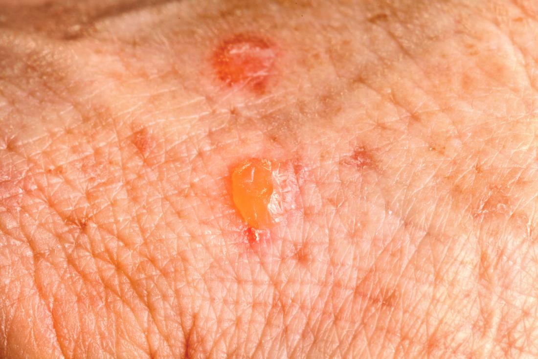 Skin cancer and rashes: Cancerous and precancerous lesions