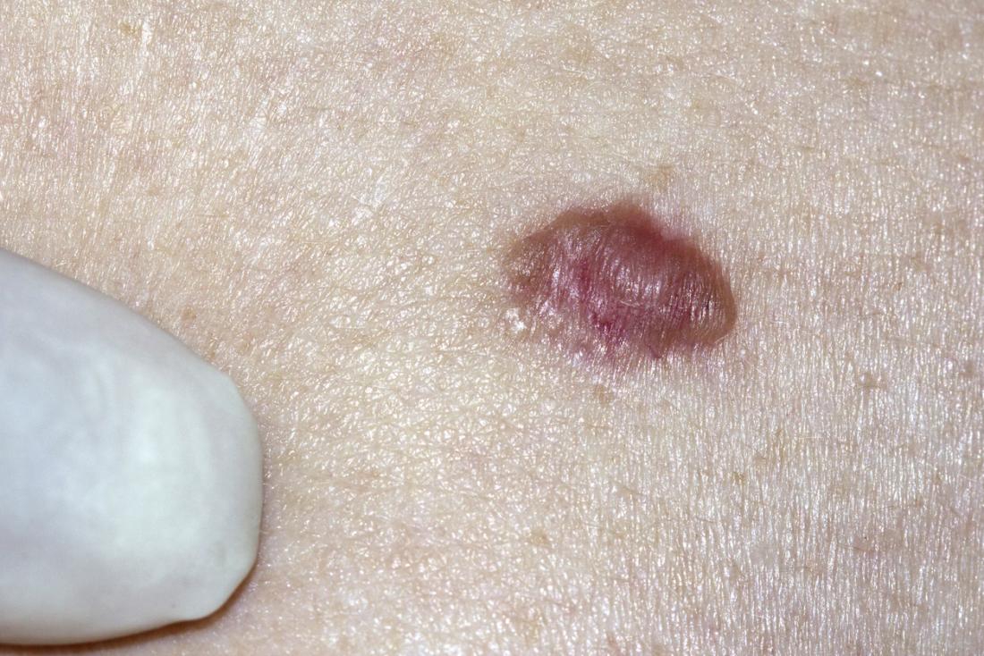 Skin cancer and rashes: Cancerous and precancerous lesions