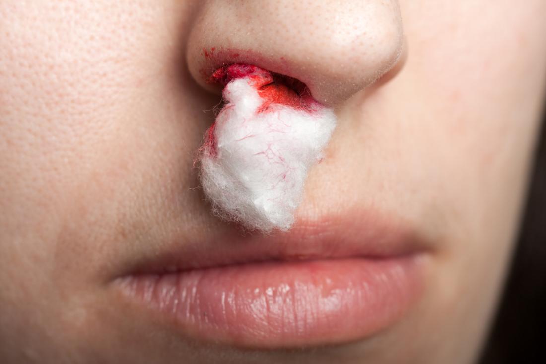 Posterior nosebleed: Causes and how to stop them