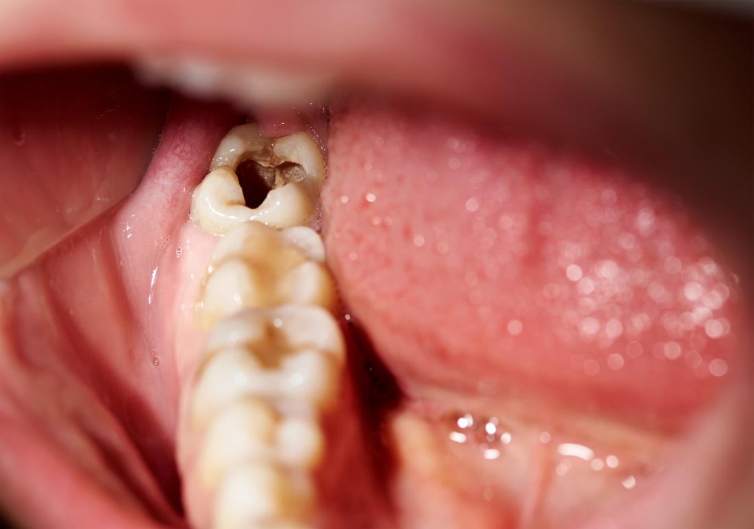 How Do You Know if Your Tooth is Rotten?