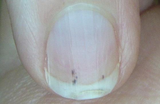 Details more than 51 black spot under nail bed latest