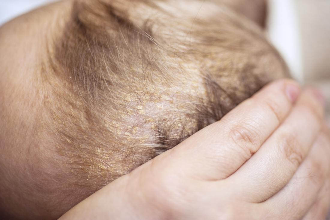 seborrheic dermatitis hair loss quora