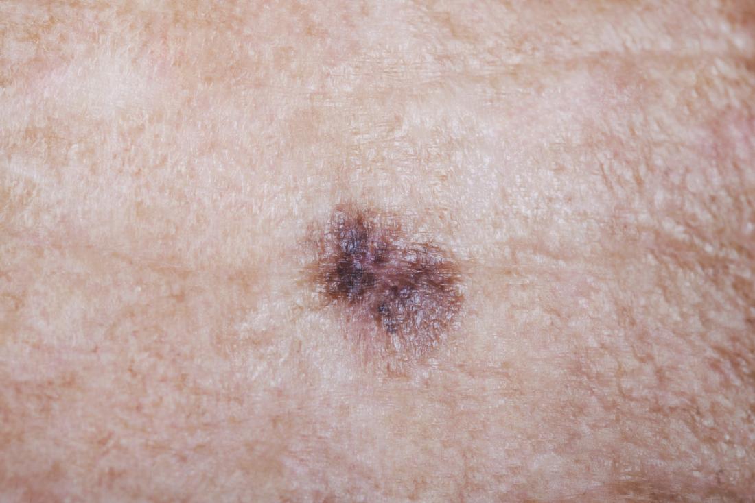 melanoma skin moles