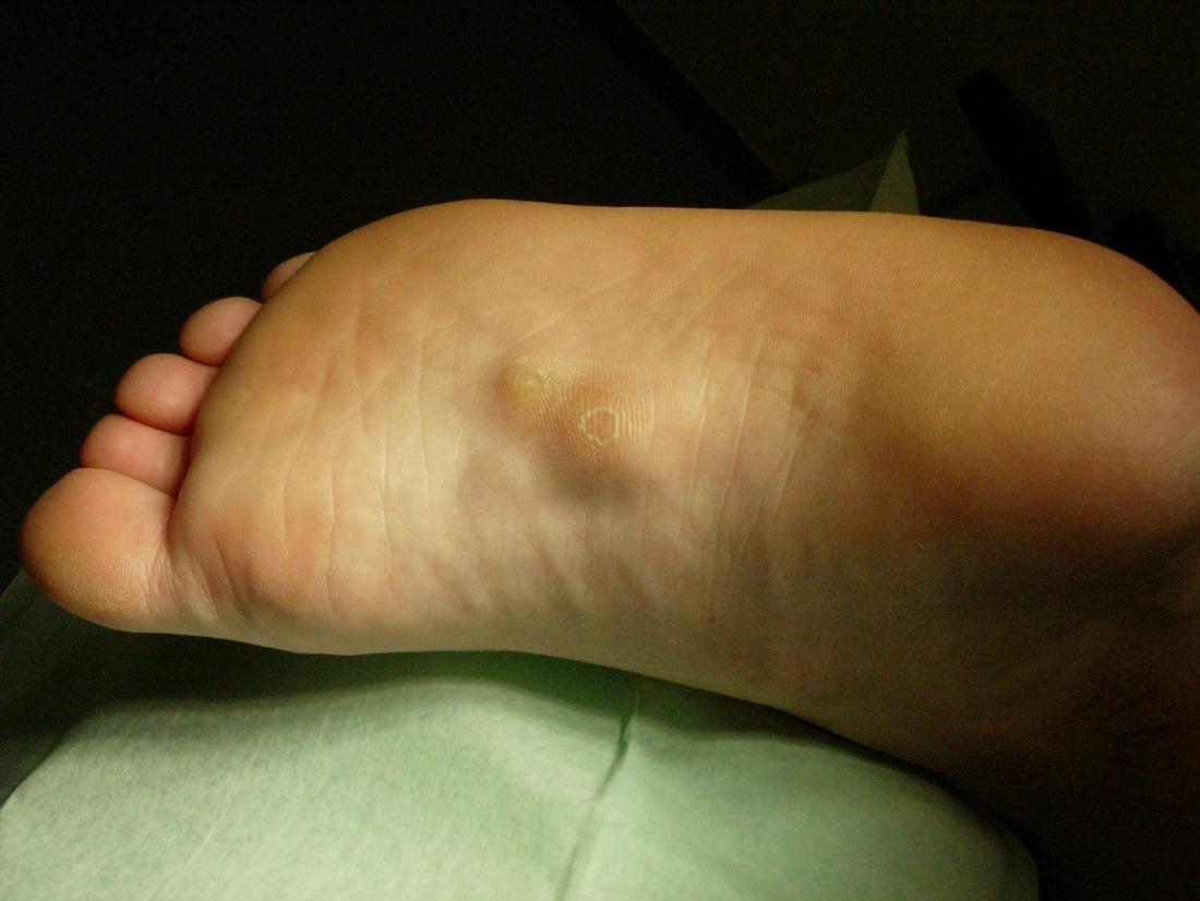 Painful Hard Bump On Bottom Of Foot