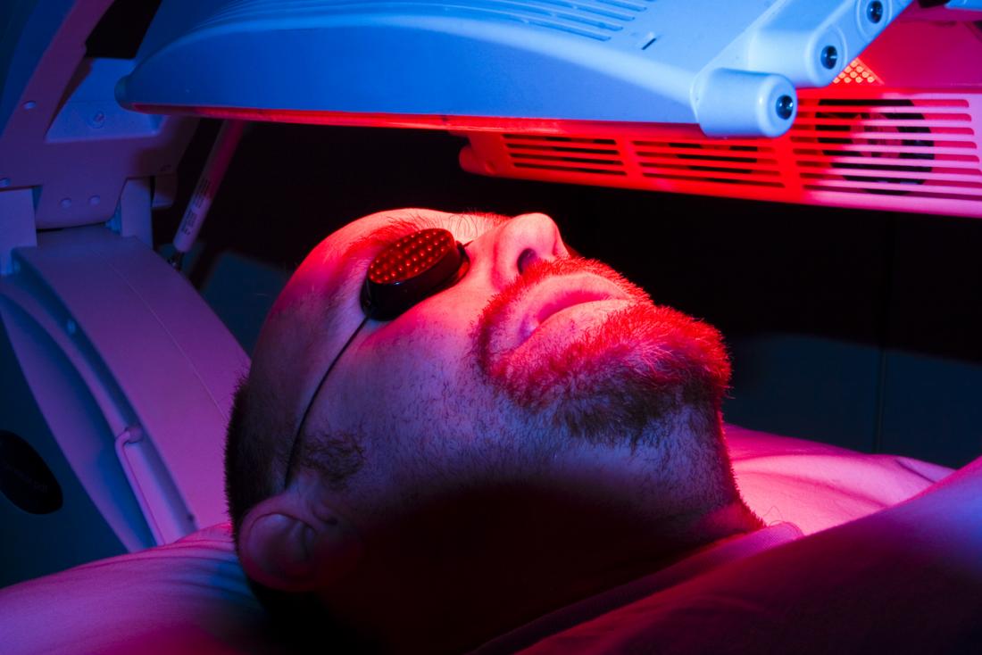 Photodynamic therapy for acne: Costs and recovery