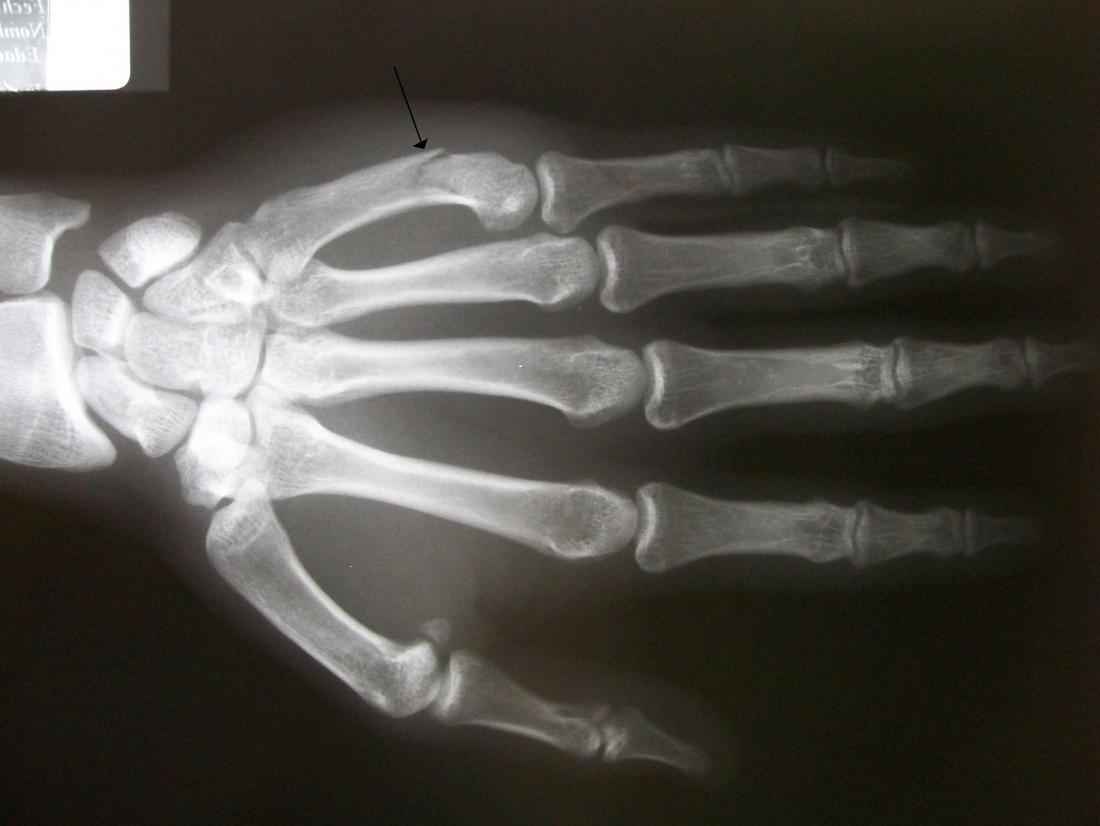 How Hand Fractures are Diagnosed and Treated