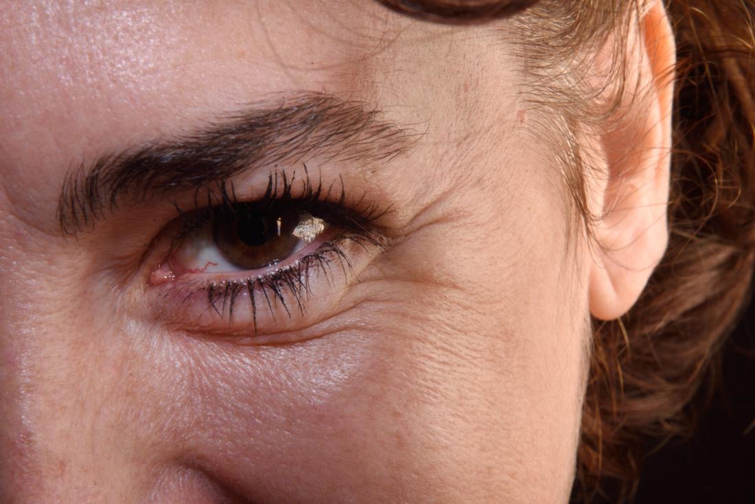 How To Get Rid Of Eye Lines, Creases & Wrinkles