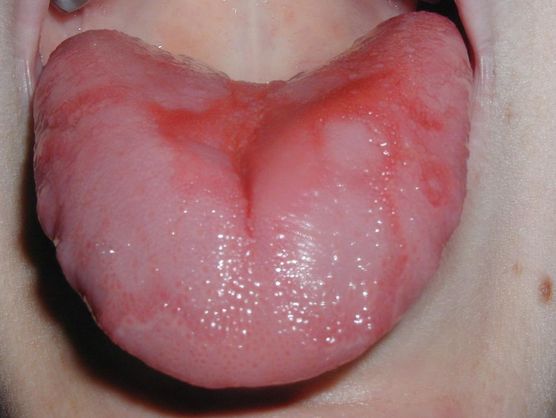 Tongue Color Chart