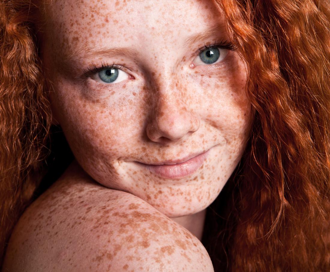 Why do redheads get melanoma more frequently?