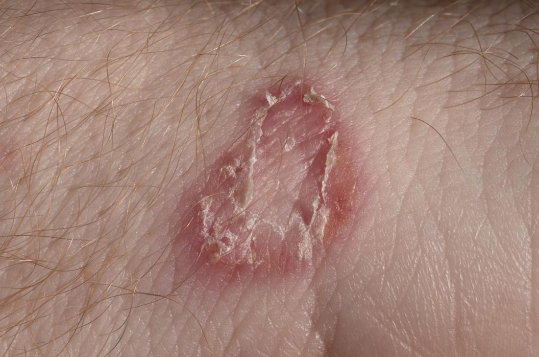 Tinea manuum is a fungal infection of the hands. Tinea causes a red, scaly  rash that usually has a border that is slightly raised. Th
