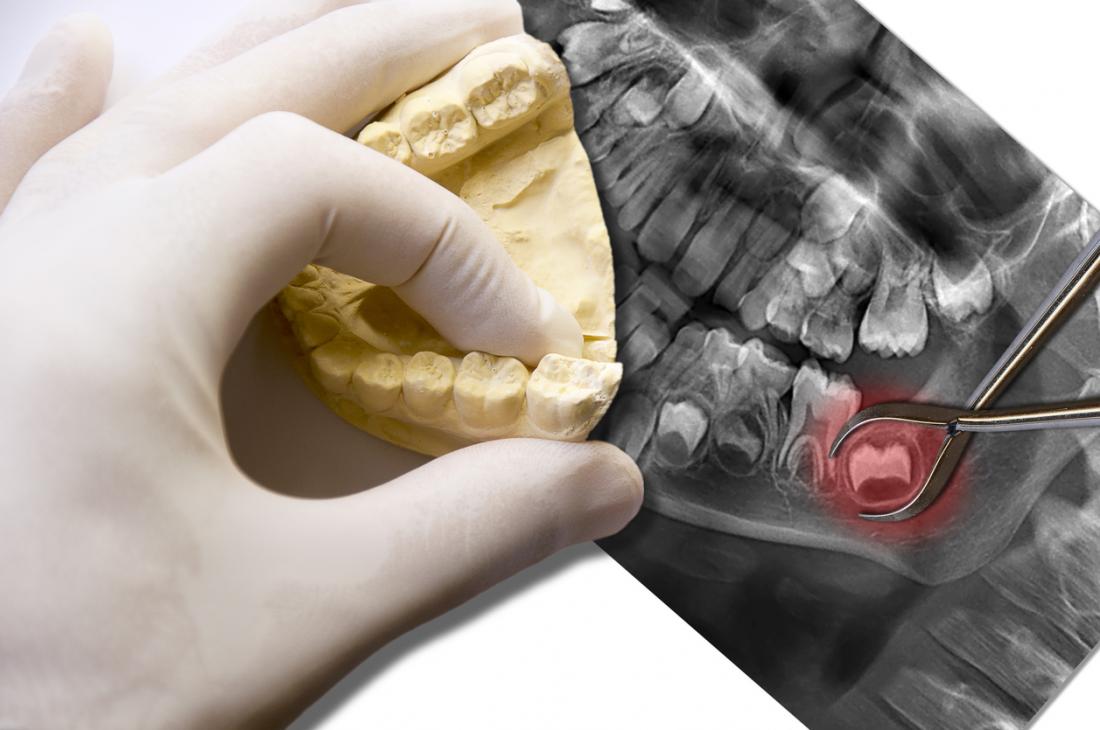 Wisdom teeth on an x-ray of the mouth, and a gloved hand looking at a model of the lower teeth on top.