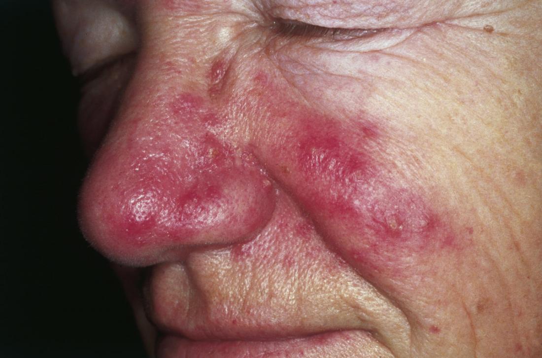 Rosacea on the face <br>Image credit: M. Sand, D. Sand, C. Thrandorf, V. Paech, P. Altmeyer, F. G. Bechara, Head & face medicine., 2010</br>