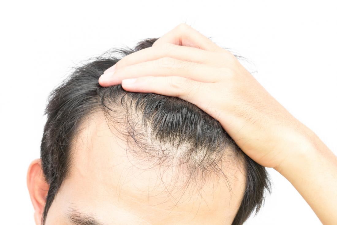 Featured image of post Steps to Prepare How To Improve Hair Growth For Male