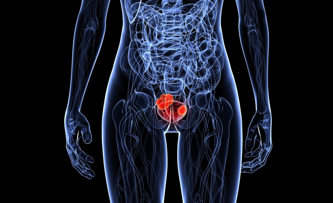 Bladder cancer