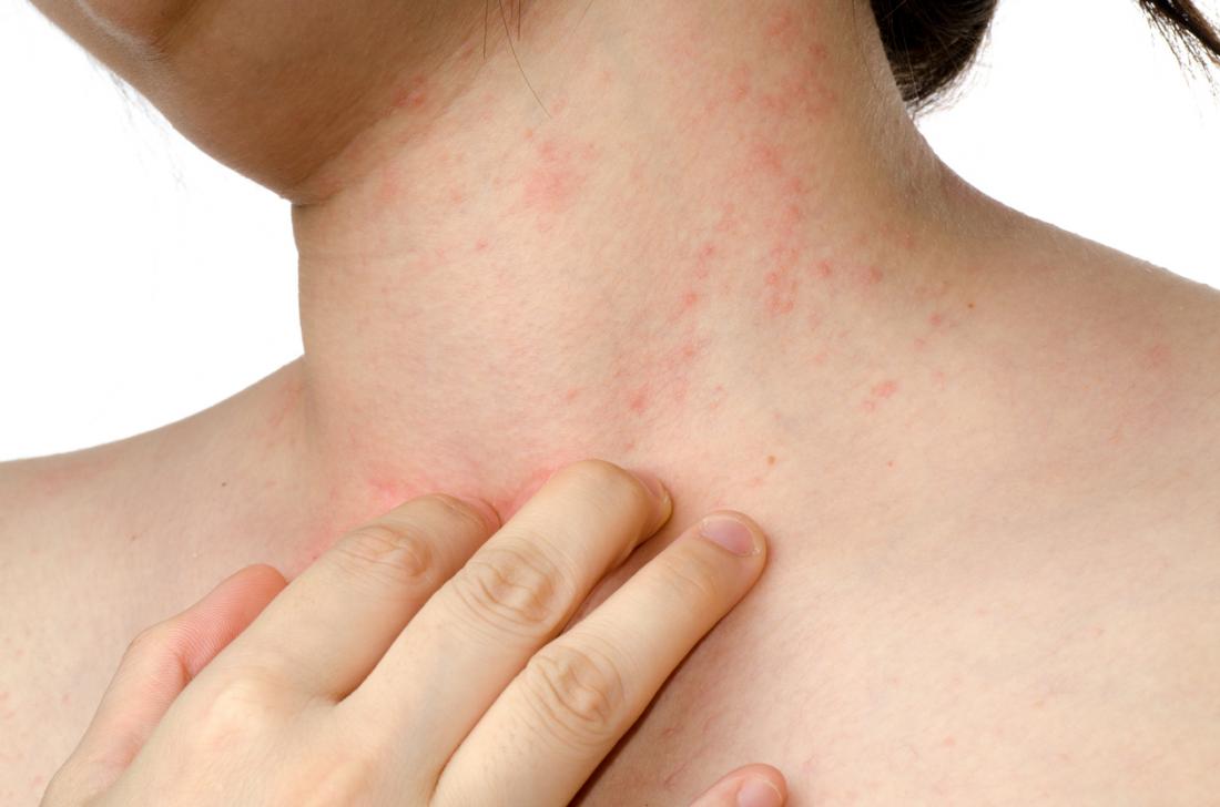 Infected Eczema Symptoms Treatment And Prevention