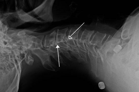 X Ray Of Vertebrae In The Neck Affected By Retrolisthesis Br Image Credit James Heilman Md 2012 March 26 Br 