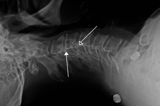 Retrolisthesis Types Causes And Symptoms   X Ray Of Vertebrae In The Neck Affected By Retrolisthesis Br Image Credit James Heilman Md 2012 March 26 Br 