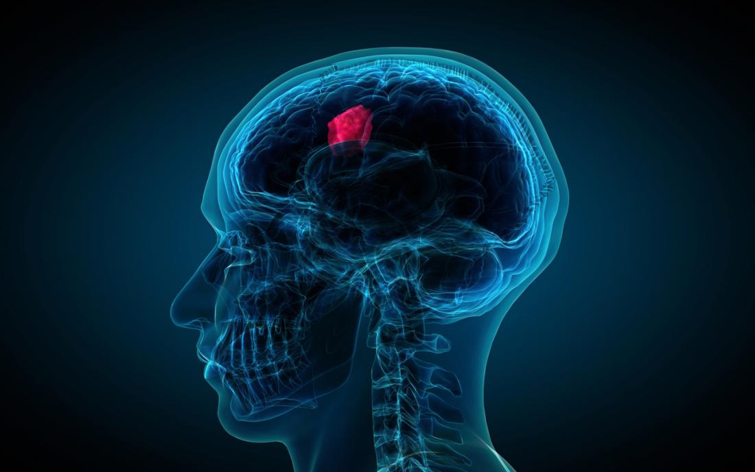 Brain tumor and cancer