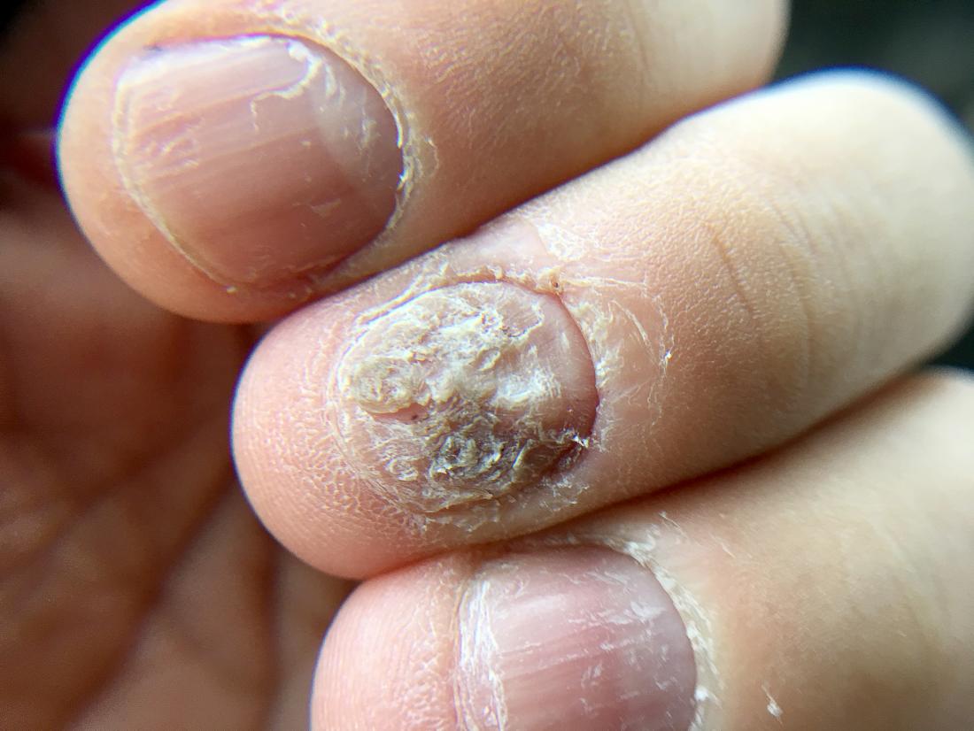 Finger Nail Fungus Best Treatment At Shannon Hill Blog