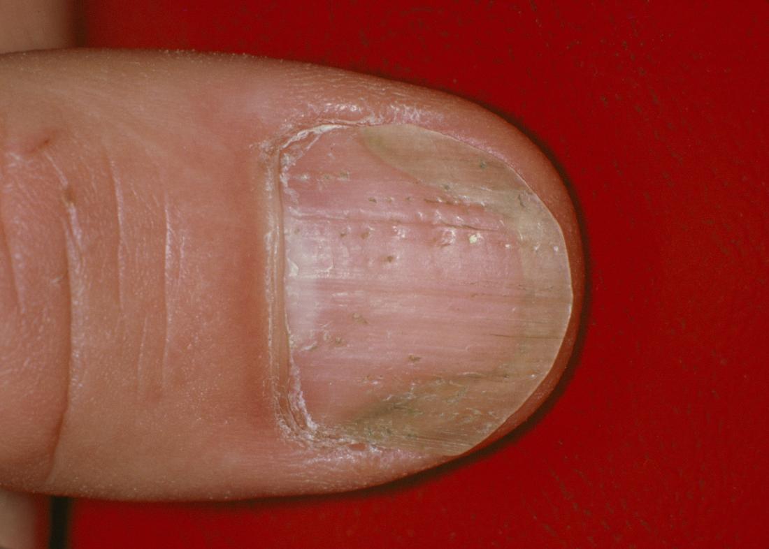 Nail Psoriasis Or Fungus Differences Symptoms And Outlook