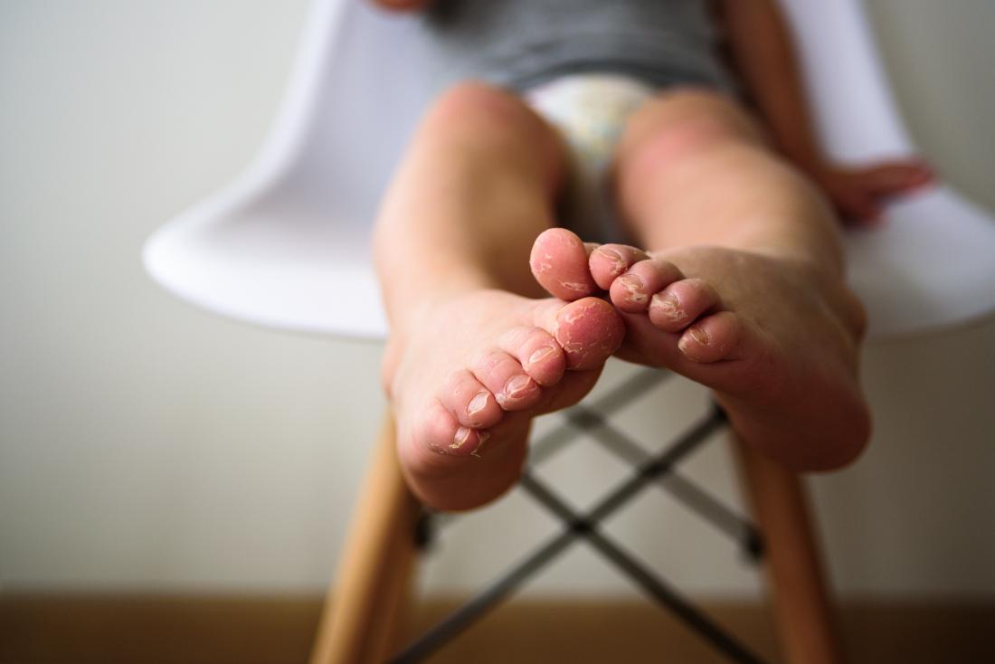 baby feet psoriasis