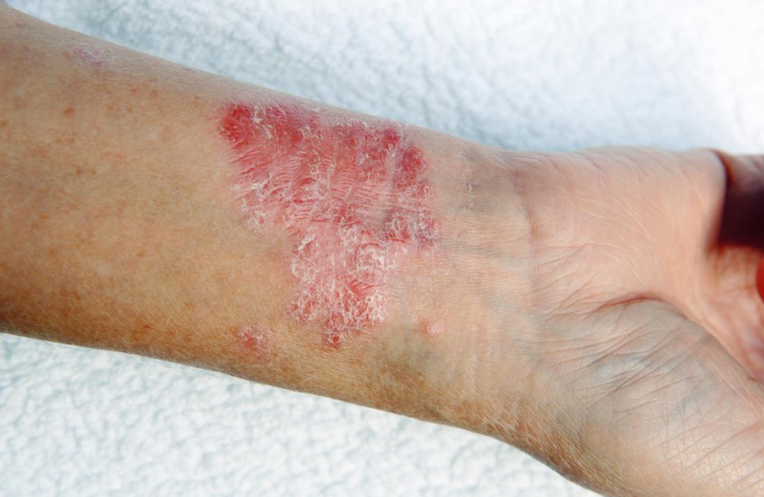 Psoriasis on the inside of a person's wrist.