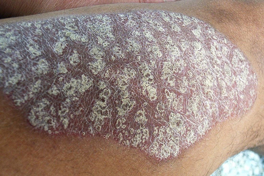 How Is Severe Psoriasis Treated Home Remedies And More