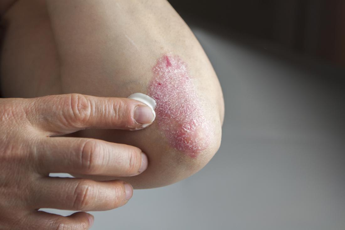 applying cream to psoriasis on elbow