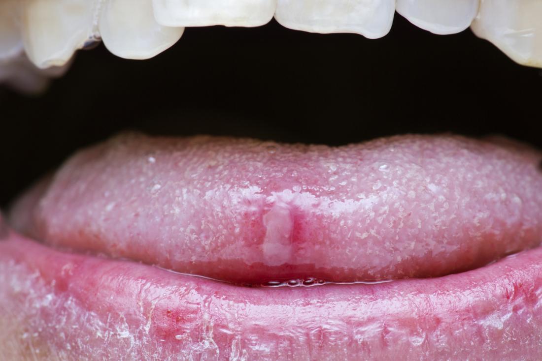 mouth-sores-cancer-stock-photos-free-royalty-free-stock-photos-from