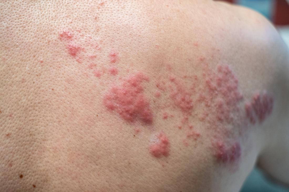 man with a shingles rash that can involve dysesthesia