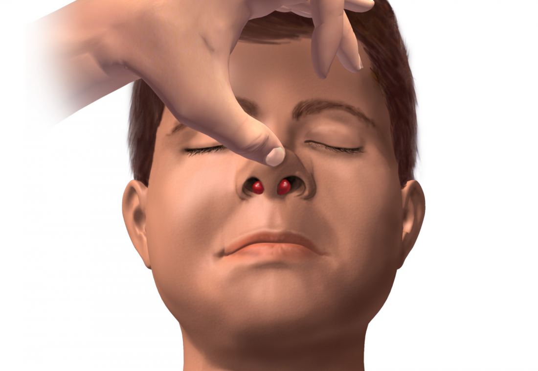 hematoma septal symptoms ematoma setto swollen sinus nostrils vessels naso lymph sull quello sapere devi nodes