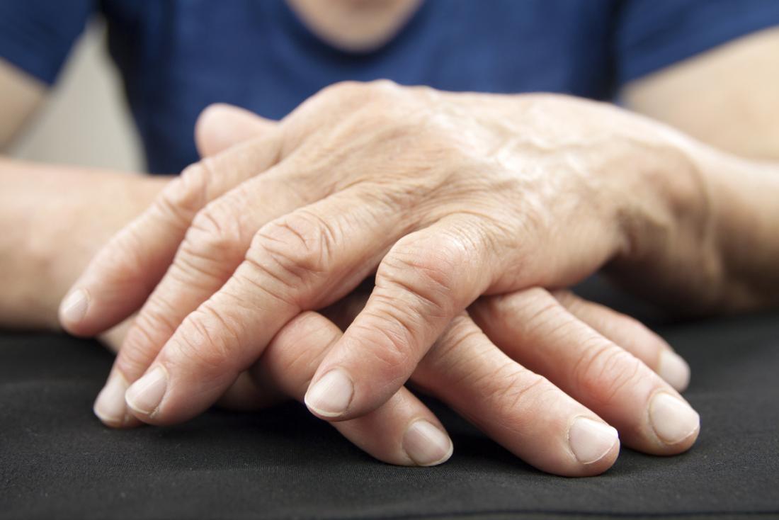 a woman with rheumatoid arthritis in her hands