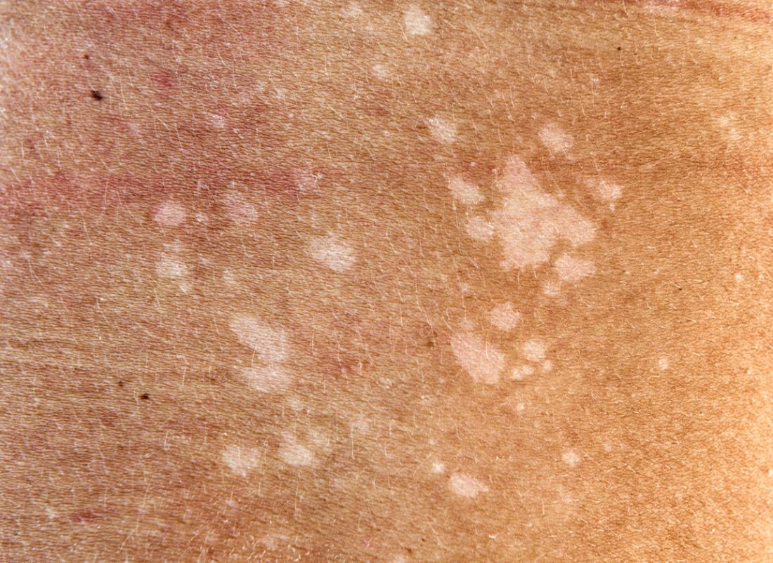 White spots on the skin: Possible causes and treatments