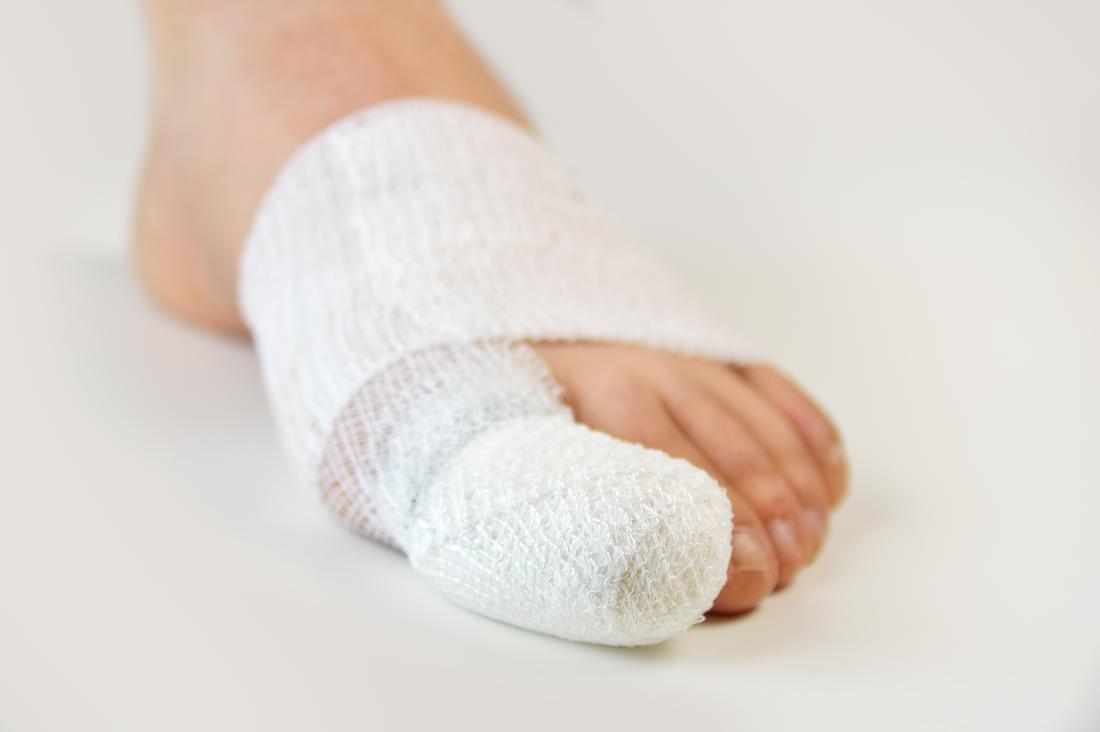 Diabetic Blisters Symptoms Treatment And Prevention