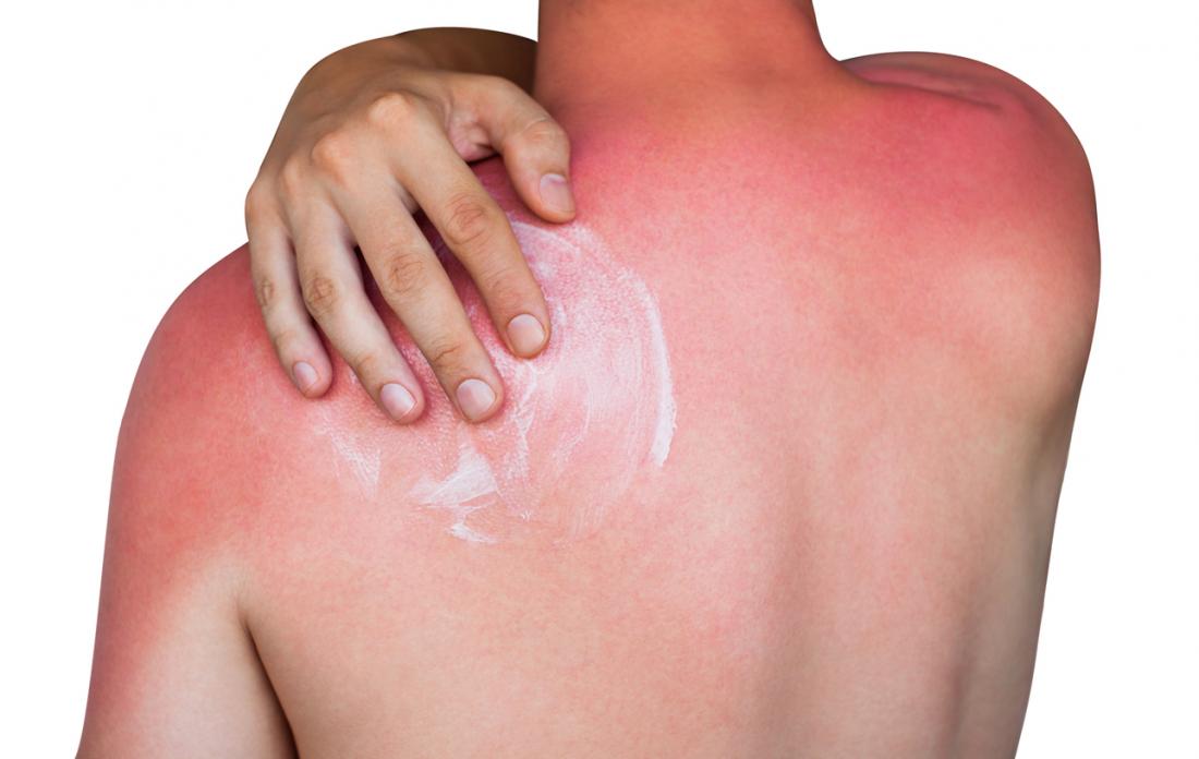 How long does sunburn last?