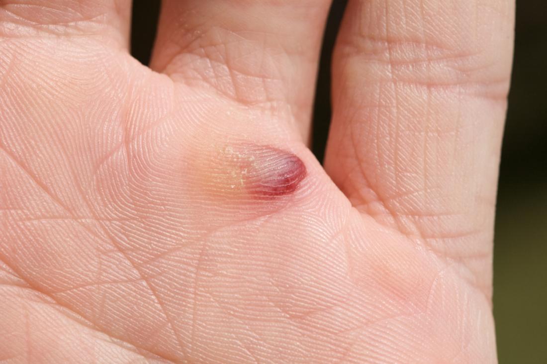 Blood blisters Causes, diagnosis, and treatment