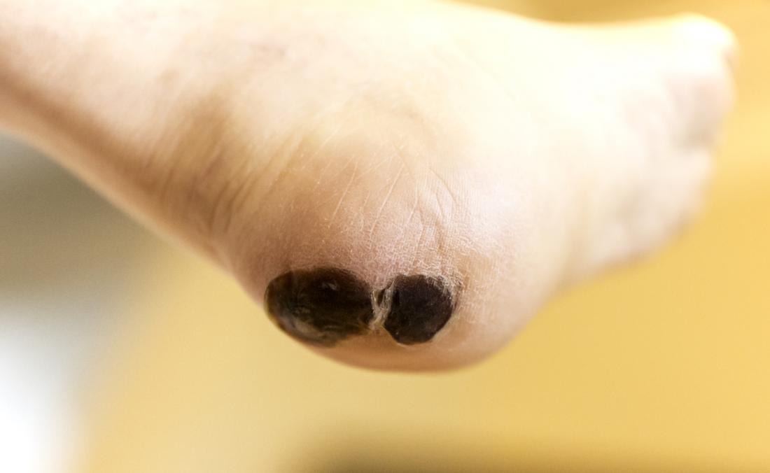 Blood blister on bottom of outlet foot