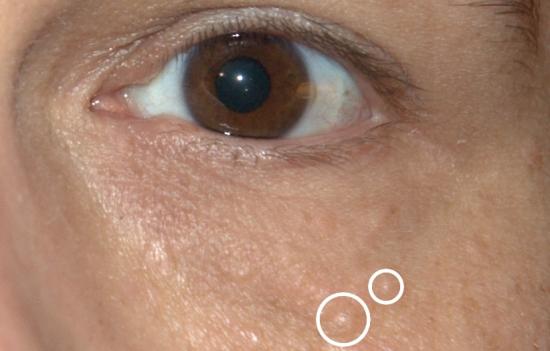 Syringoma Pictures Treatment And Removal