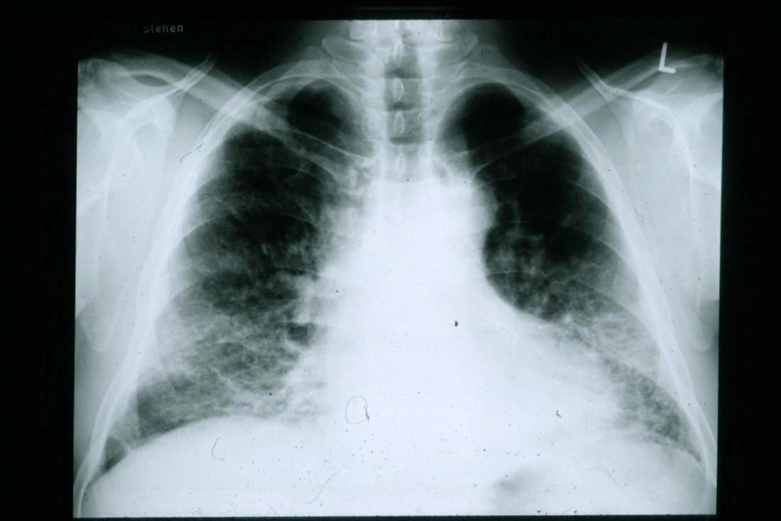 Lung scarring and idiopathic pulmonary fibrosis