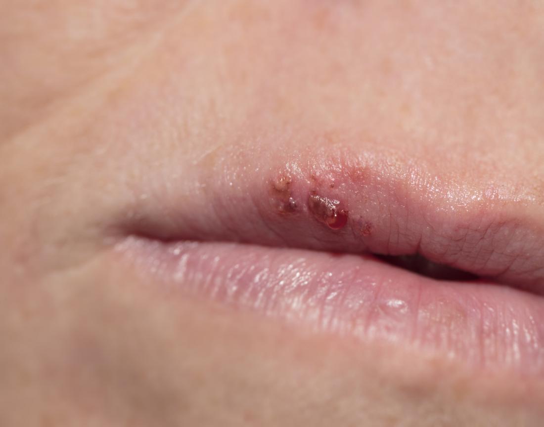 Cold sore on a top lip