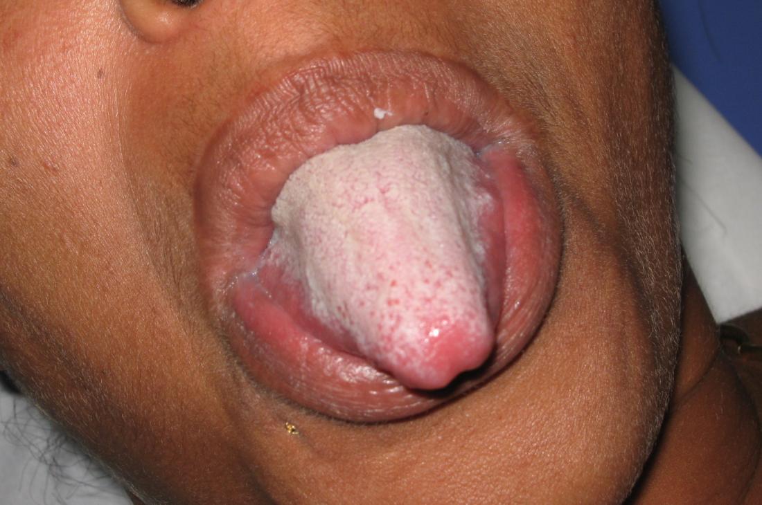 White tongue.<!--mce:protected %0A--> <br />Image credit: Grook da oger, (2012, April 6)</br>