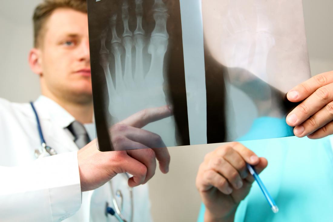 Hairline fracture: Symptoms, treatment, and causes