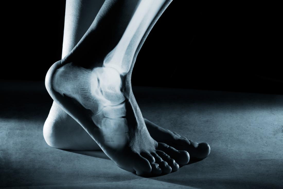 stress fracture in heel of foot