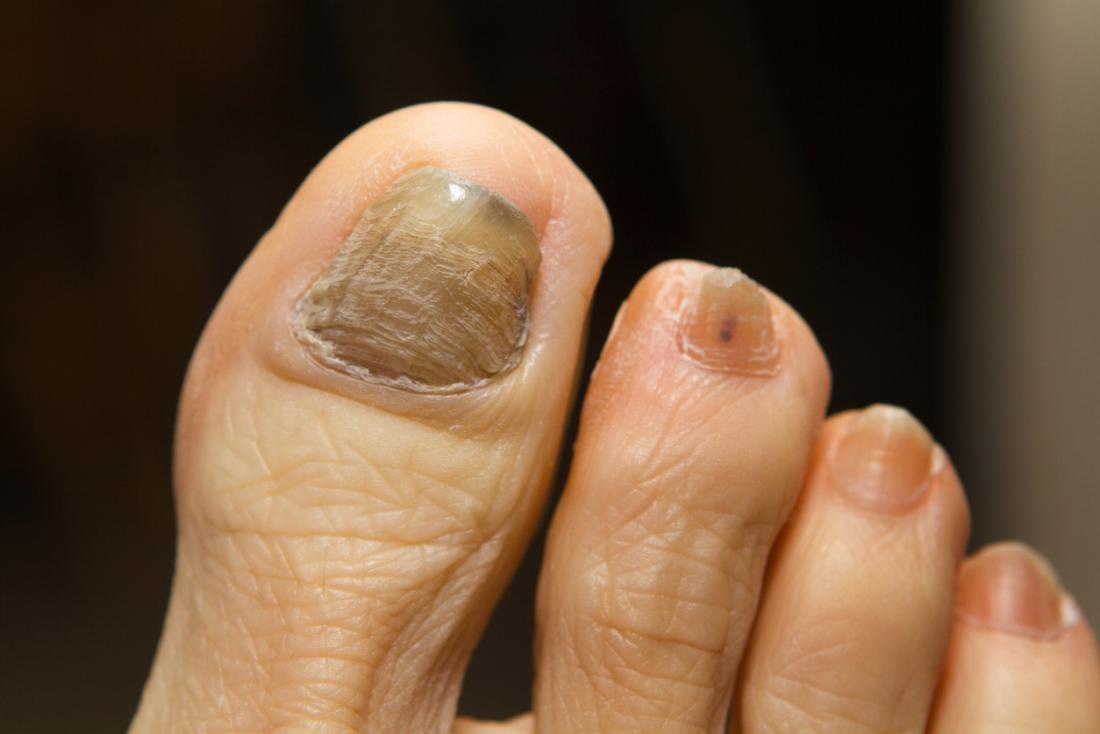 Chemotherapy fungal infection in toenails.