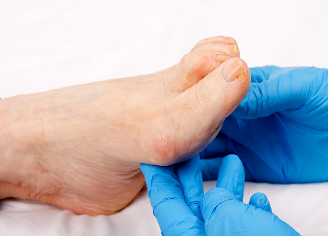 Senior persons foot showing signs of thickened toenails from aging.