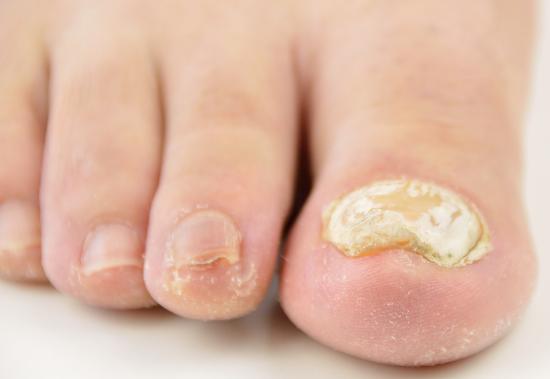 Thick toenail with white fungus.